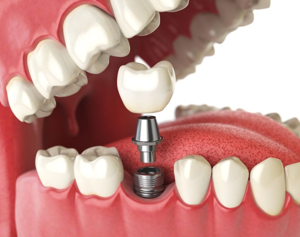 Dental Implant Treatement